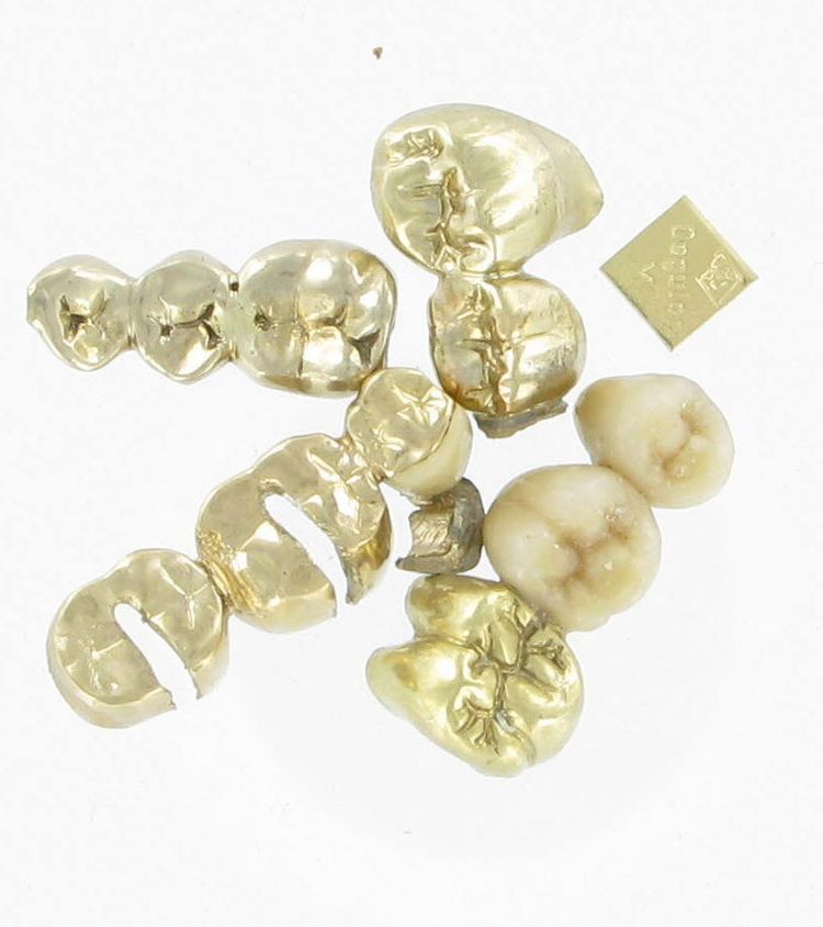 Goldfarbene Zahnkronen und Dentalgold